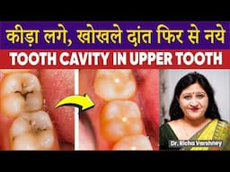 Upper Teeth Decay | Cavity Removal at Home