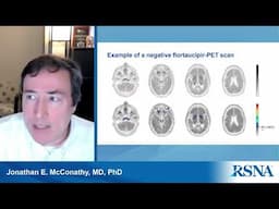 Unlocking the Radiologist’s Role in Alzheimer’s Diagnosis and Treatment