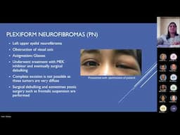 Pediatric Manifestations of Neurofibromatosis Type 1  Pediatric Grand Rounds Meeting 11 15 24