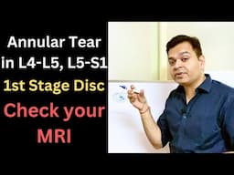 What is Annular Tear, Disc Bulge L4-L5, Slipped Disc, Lumbar Spine MRI, Low Back Pain Causes