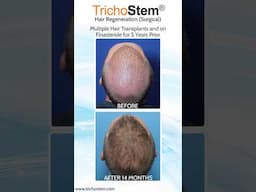 How Hair Transplant Results can be Further Improved Without Surgery #hairtransplant