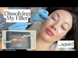 I Dissolved My Filler...AGAIN! Ultrasound-Guided Filler Dissolving Process