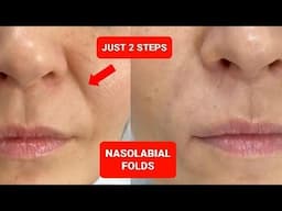 Two techniques to reduce those NASOLABIAL FOLDS