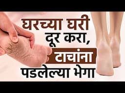 घरच्या  उपचारांनी टाचांच्या भेगा करा दूर | Get Rid Of Dry Skin | Skincare Tips For Winter | SI2