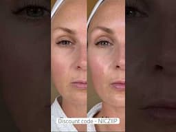 ZIIP at home Botox device /ad