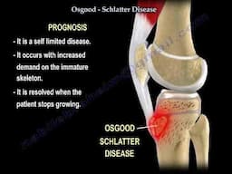 Osgood-Schlatter Disease