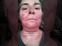 Testimonio Sra. Alicia, un caso de lupus. Biaani Medicina Integrativa