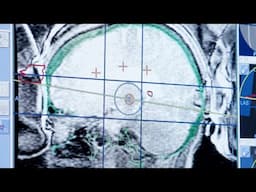 A Steady Hand: Treating Essential Tremor with Focused Ultrasound