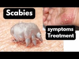 Scabies cause, diagnosis and treatment in hindi | scabies symptoms | How to get rid of scabies