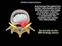 Sciatica Impersonators Explained: Top Causes, Symptoms, and Treatments You Must Know