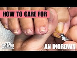 Deep Grooves Ingrown Toenail Big Toe