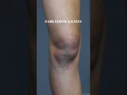 Dark Elbow & Knees Ka Permanent Solution | #youtubeshorts #skincare