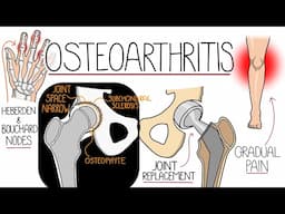 Osteoarthritis Explained Clearly