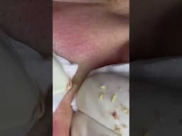 Big Cystic Acne Blackheads Extraction Blackheads & Milia, Whiteheads Removal Pimple Popping #shorts