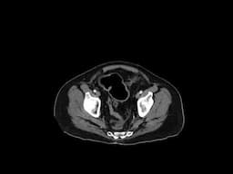 Cecal cancer causing SBO