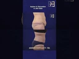 Fleur de Lis Abdominoplasty Including VASER Liposuction (Patient 2022-1035) #shorts