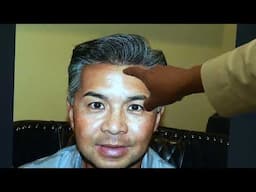 Success Story: Transforming Frontal Hair Thinning in an Asian Male in Los Gatos