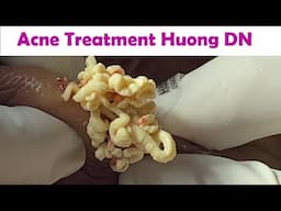 Acne Treatment Huong Da Nang# _ 2024   #Acne Huong 715