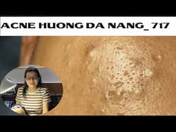 Acne Treatment Huong Da Nang# 717 |   #Remove Blackheads