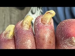 Extreme Toenail Cutting on a Blood-Thinner Patient - Will It Bleed?!