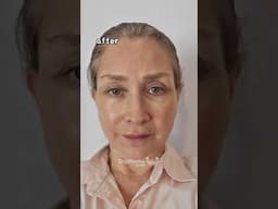 Anti-aging surgeries in Korea💗 #facelift #plasticsurgerykorea #antiaging