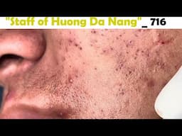 Staff of Huong Da Nang. Very severe acne in a preteen patient. Extracts blackheads#716