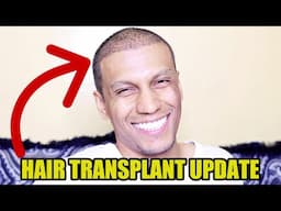 HAIR TRANSPLANT 3 WEEKS UPDATE ! IS IT A SUCCESS ??