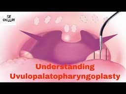 Animated Coblation assisted uvulopalatopharyngoplasty technique