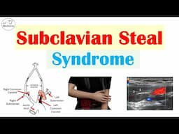 Subclavian Steal Syndrome (“Stealing Blood From Brain”) Risk Factors, Symptoms, Diagnosis, Treatment