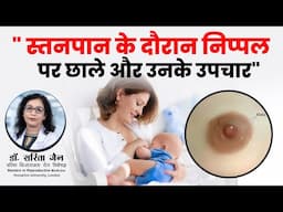 Milk Blebs During Breastfeeding: Causes and Remedies  | Dr Sarita Jain