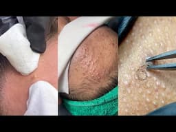 8 Minutes Of Top ASMR Pimple Popping Video