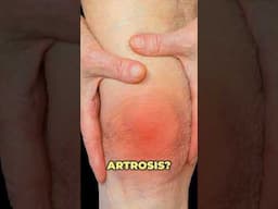 Artritis vs artrosis ¿ Cuáles son las diferencias? #artritis #artrosis  #rodilla #drwilsondelgado