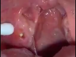 Tonsil Stone Removal