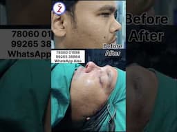 Rhinoplasty In Delhi Mumbai Bangalore Kolkata Hyderabad Chandigarh Nagpur Raipur Surat Indore Goa