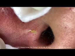 Big Cystic Acne Blackheads Extraction Blackheads & Milia, Whiteheads Removal Pimple Popping