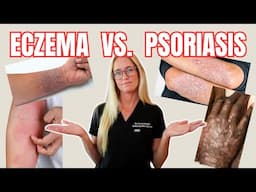 5 Key Differences Between ECZEMA vs. PSORIASIS | Light Skin vs. Dark Skin