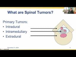 Understanding and Treating Spinal Tumors