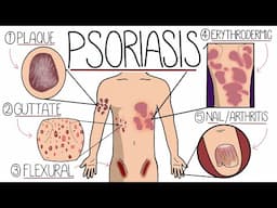 Psoriasis Explained Clearly - Including Types and Treatment