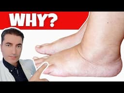 When should i worry about my legs swelling? These are the most dangerous causes...