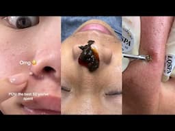 6 Minutes Of Top ASMR Pimple Popping Video