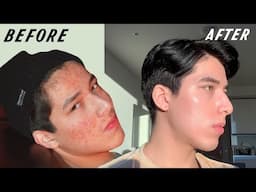 how i FINALLY cleared my acne: skincare, medication, diet? (scientific evidence)