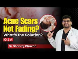 क्या Acne Scars को Treat किया जा सकता है? | Top Treatments for Acne Scars: Q&A | Clear Skin, Pune