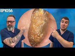 MESSY KERATOSIS OBTURANS - HUGE EAR WAX & SKIN PLUG REMOVAL - EP1056