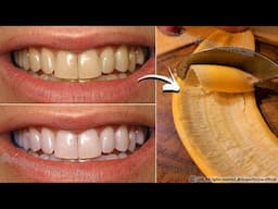 Teeth Whitening in Just 2 Minutes - Turn Yellowing and Tartar Buildup into Shiny Milky White 🦷