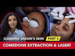 Three Sessions In! Sakshi’s Clear Skin Progress with Fotona Laser Treatment |Clear Skin Clinic, Pune