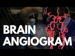 Angiogram - BRAIN angio procedure video