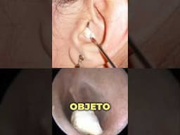 Haz esto si tienes un objeto extraño en el oído 👂 #drwilsondelgado #oido #tipsdesalud