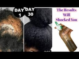 I AM STILL SHOCKED 😳, Use This To Stop Hair Fall, Baldness & Breakage Fast, Unstoppable Hair Growth