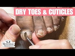 Discolored Dry Toenails Transformation