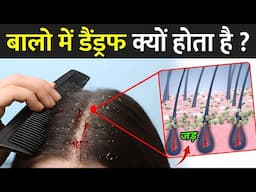 बालो में डैंड्रफ क्यों होता है ? | Balo Me Dandruff Kyu Hota Hai | Hair Dandruff Kyu Hota Hai